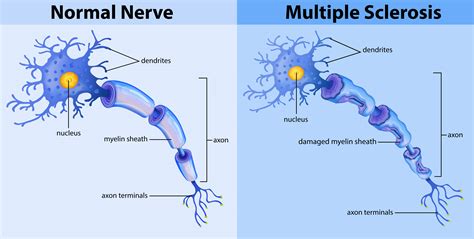 Does MS Show Up on Nerve Conduction Study: Exploring the Intersection of Neurology and Diagnostic Techniques